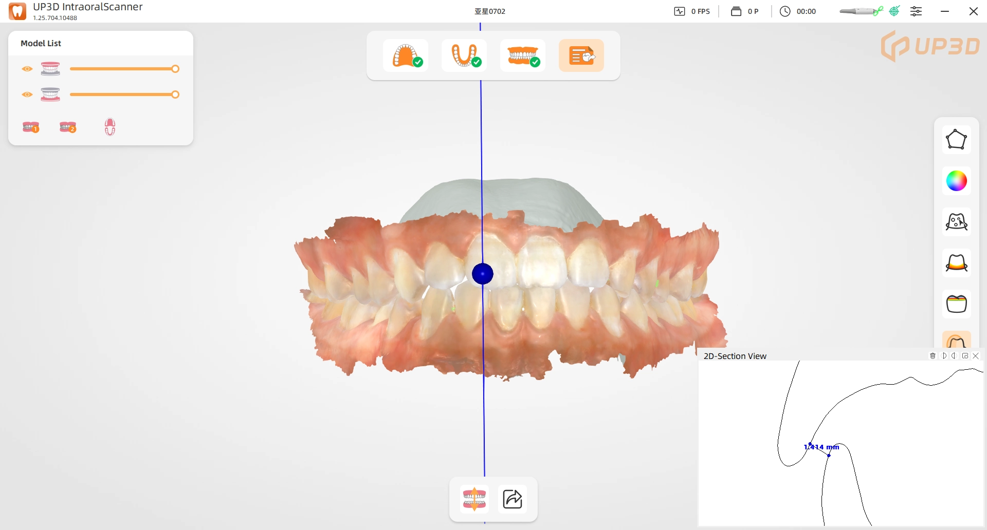 UP3D UP610 intraoral scanner 2D section measurement feature showing accurate visualization of restoration and occlusion distance in dental scans.