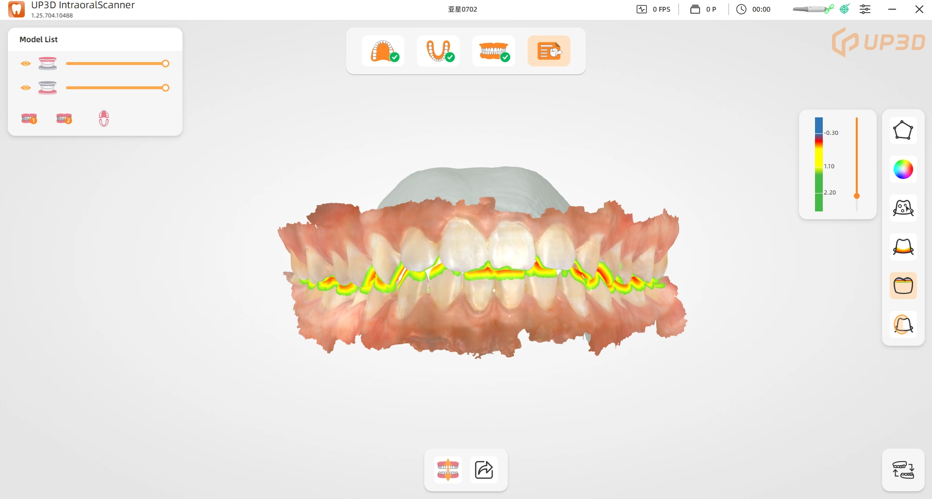 UP3D UP610 intraoral scanner occlusal distance map feature showing maxilla-mandible interference with a color visualization.