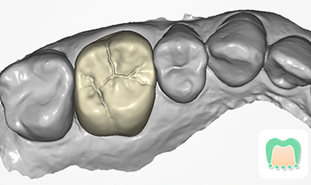 UPCAD – Smarter, Intuitive Dental CAD | UP3D