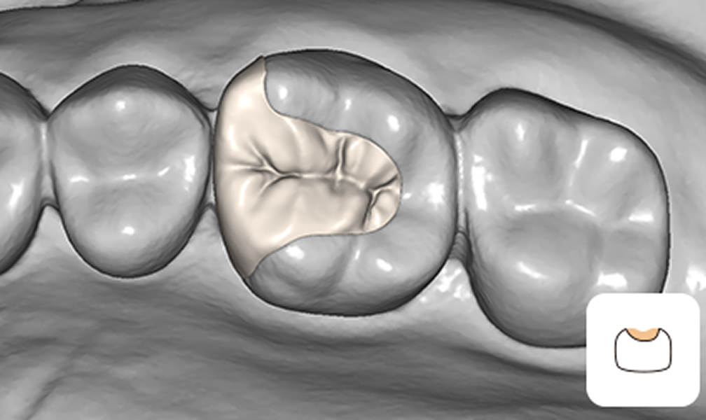 UPCAD – Smarter, Intuitive Dental CAD | UP3D